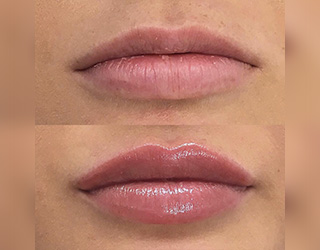 Aumento de Labios