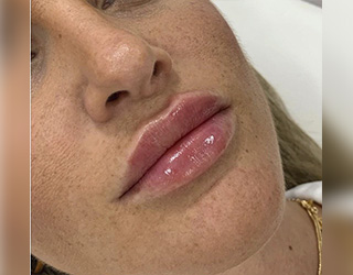 Aumento de Labios