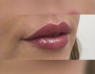 Aumento de Labios