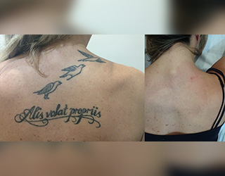 Borrado de Tatuajes