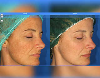 Melasma