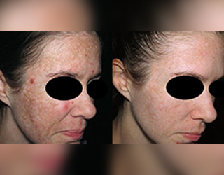 Melasma