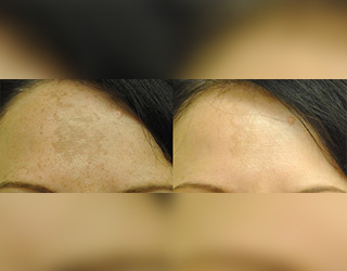 Melasma