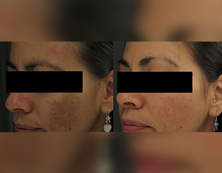 Melasma