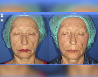 Rejuvenecimiento Facial