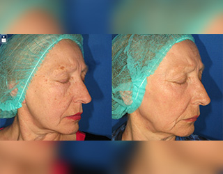 Rejuvenecimiento Facial