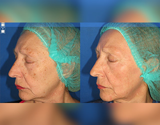 Rejuvenecimiento Facial