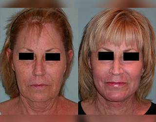 Rejuvenecimiento Facial