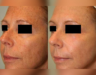 Rejuvenecimiento Facial