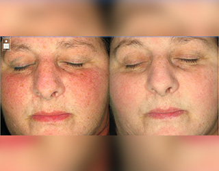 Rosacea (Couperose)