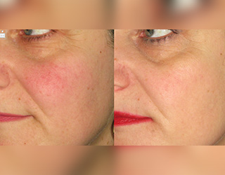 Rosacea (Couperose)