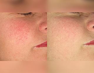 Rosacea (Couperose)