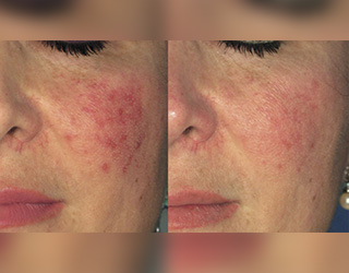 Rosacea (Couperose)