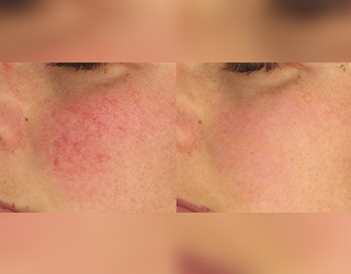 Rosacea (Couperose)